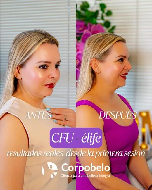 Tratamiento facial CFU-élife para renovar la piel